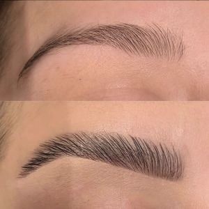 Brow lift
